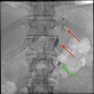 Cisterna chyli and proximal TD